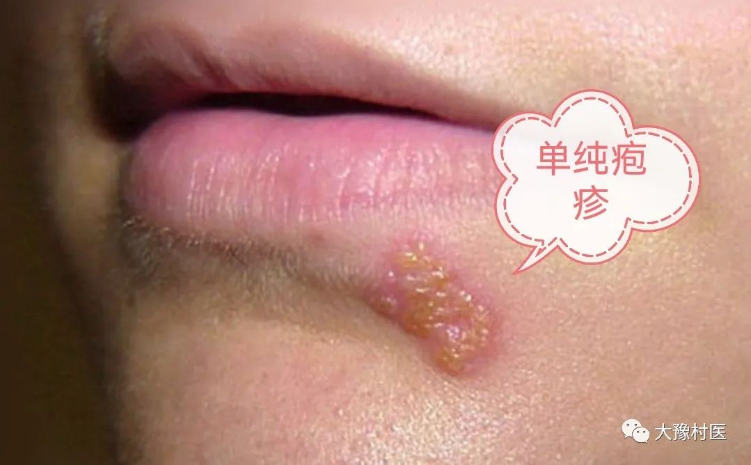 最新疱疹治疗方法,曙光初现的希望之光