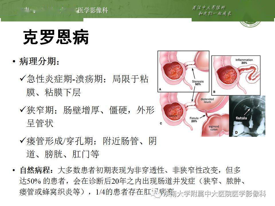 克罗恩病最新突破性研究,未来治疗的新希望与进展